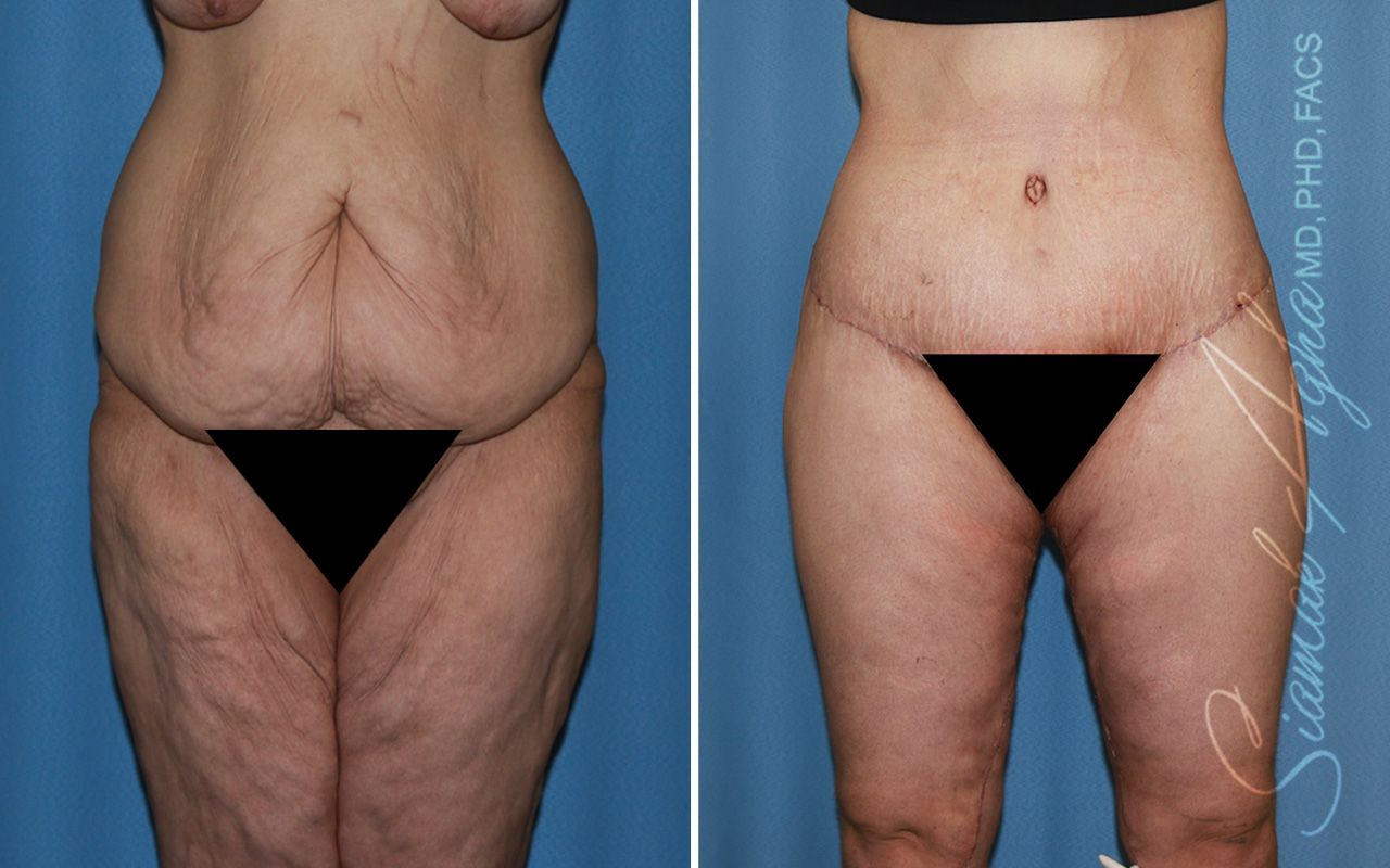 Vertical Thigh Lift Before & After