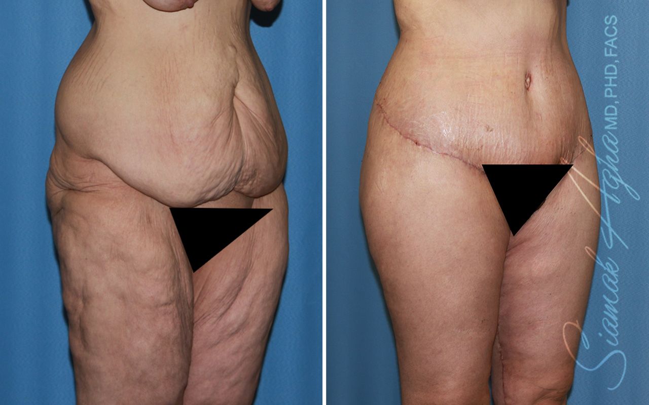 Vertical Thigh Lift Before & After