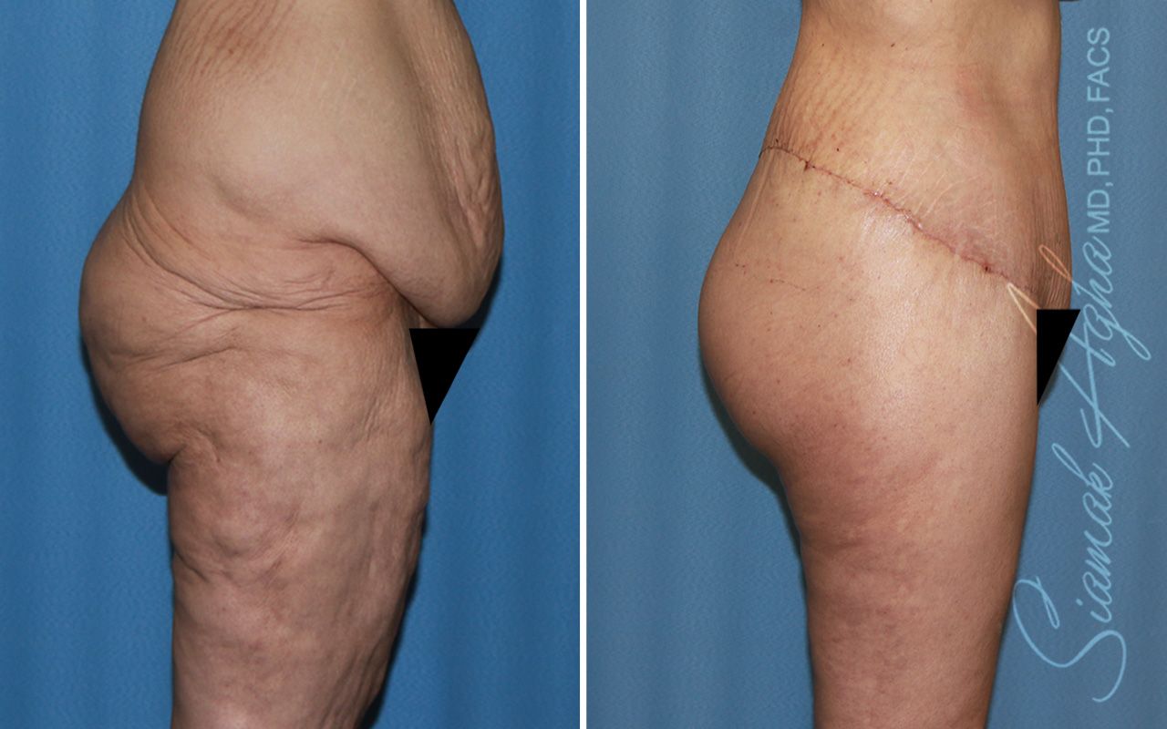 Vertical Thigh Lift Before & After
