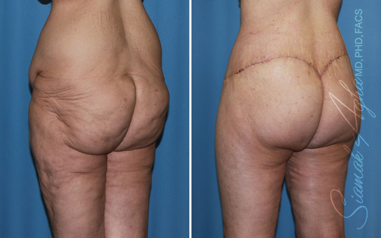 Vertical Thigh Lift Before & After