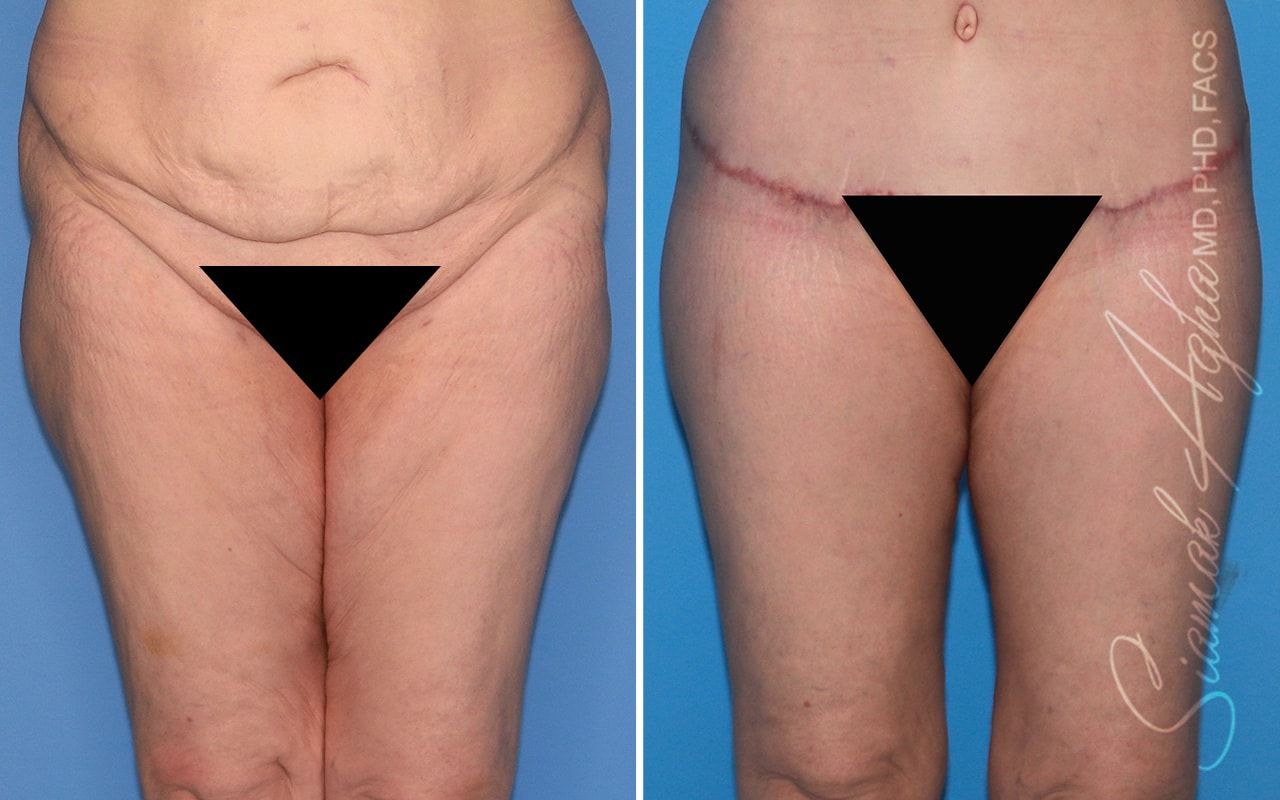 Vertical Thigh Lift Before & After