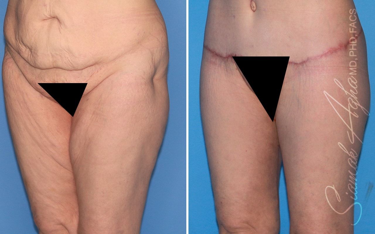 Vertical Thigh Lift Before & After