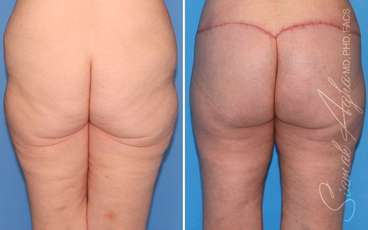 Vertical Thigh Lift Before & After