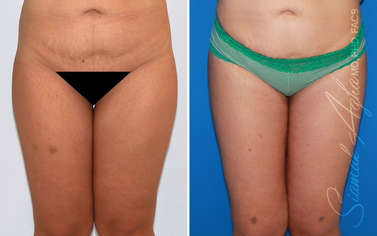 Vertical Thigh Lift Before & After