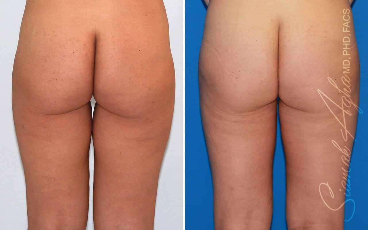 Vertical Thigh Lift Before & After