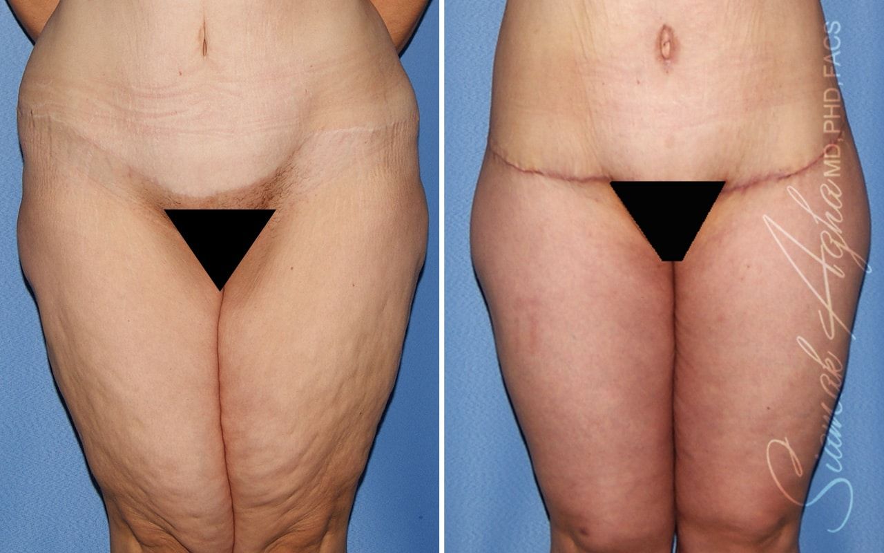 Vertical Thigh Lift Before & After