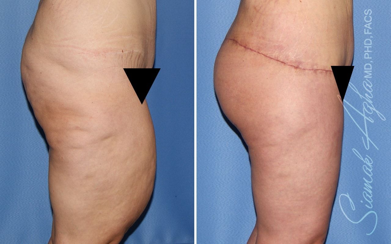 Vertical Thigh Lift Before & After