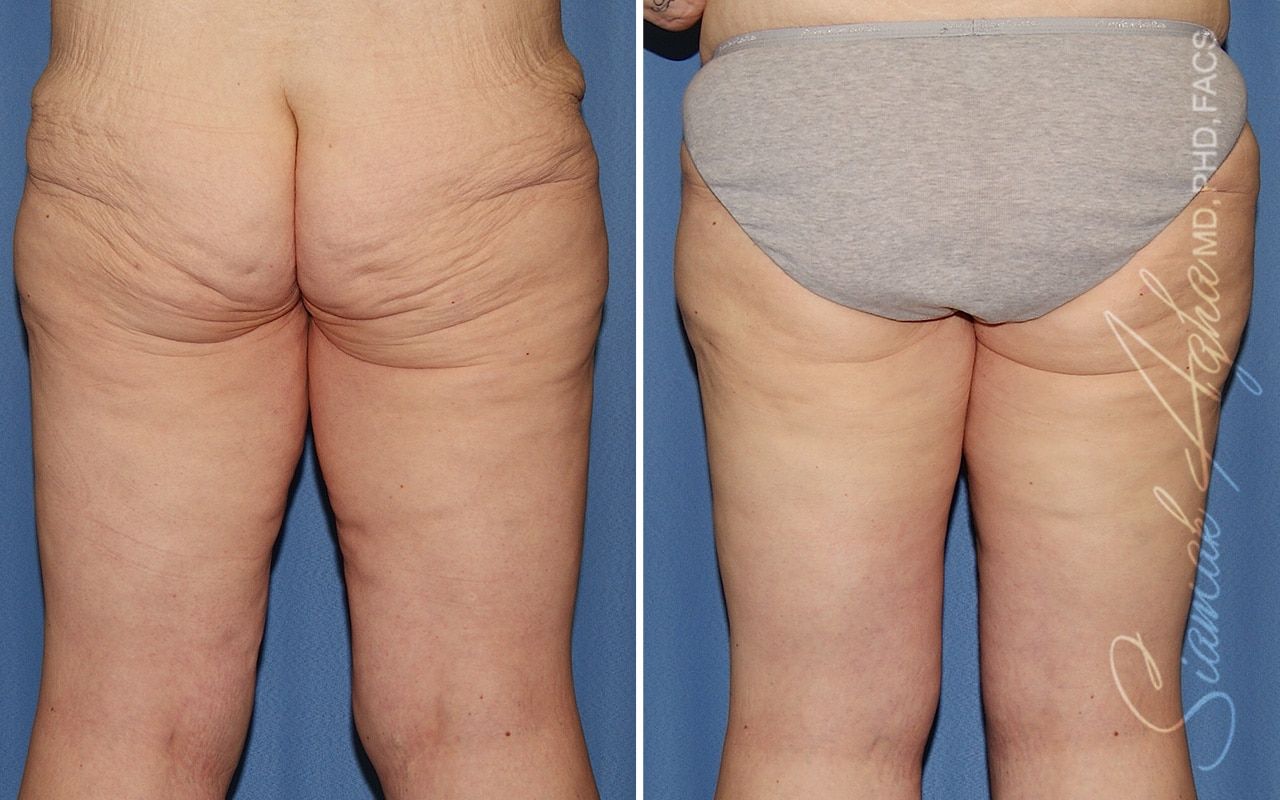 Vertical Thigh Lift Before & After