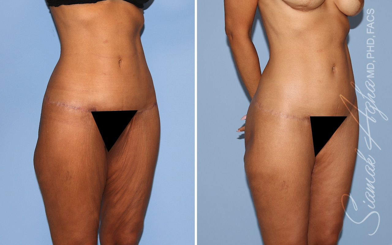 Vertical Thigh Lift Before & After