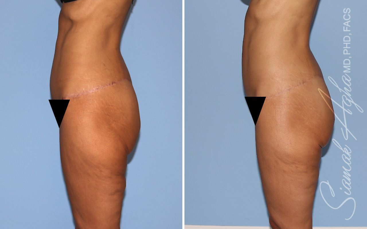Vertical Thigh Lift Before & After