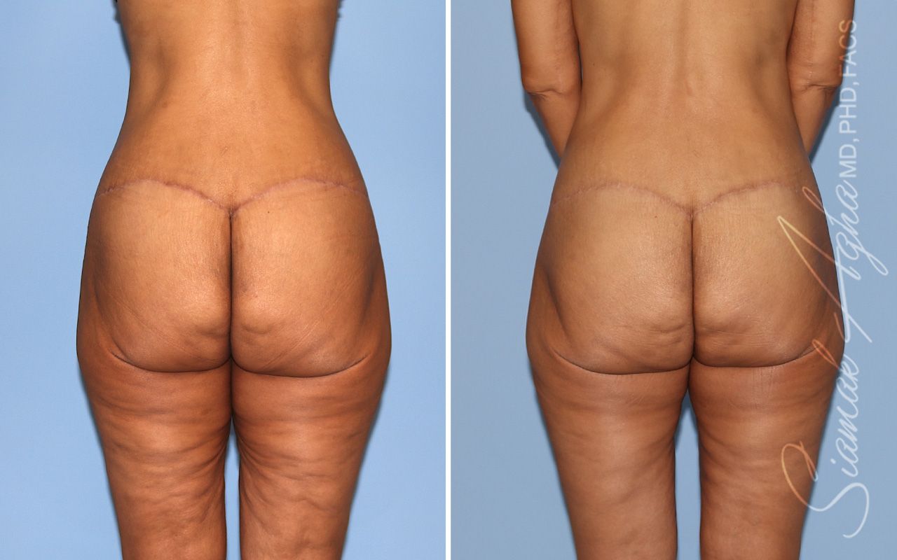 Vertical Thigh Lift Before & After