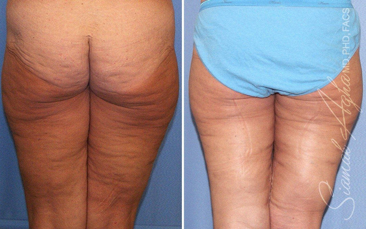 Vertical Thigh Lift Before & After