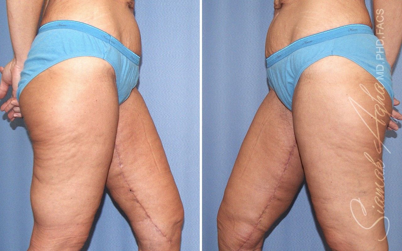 Vertical Thigh Lift Before & After