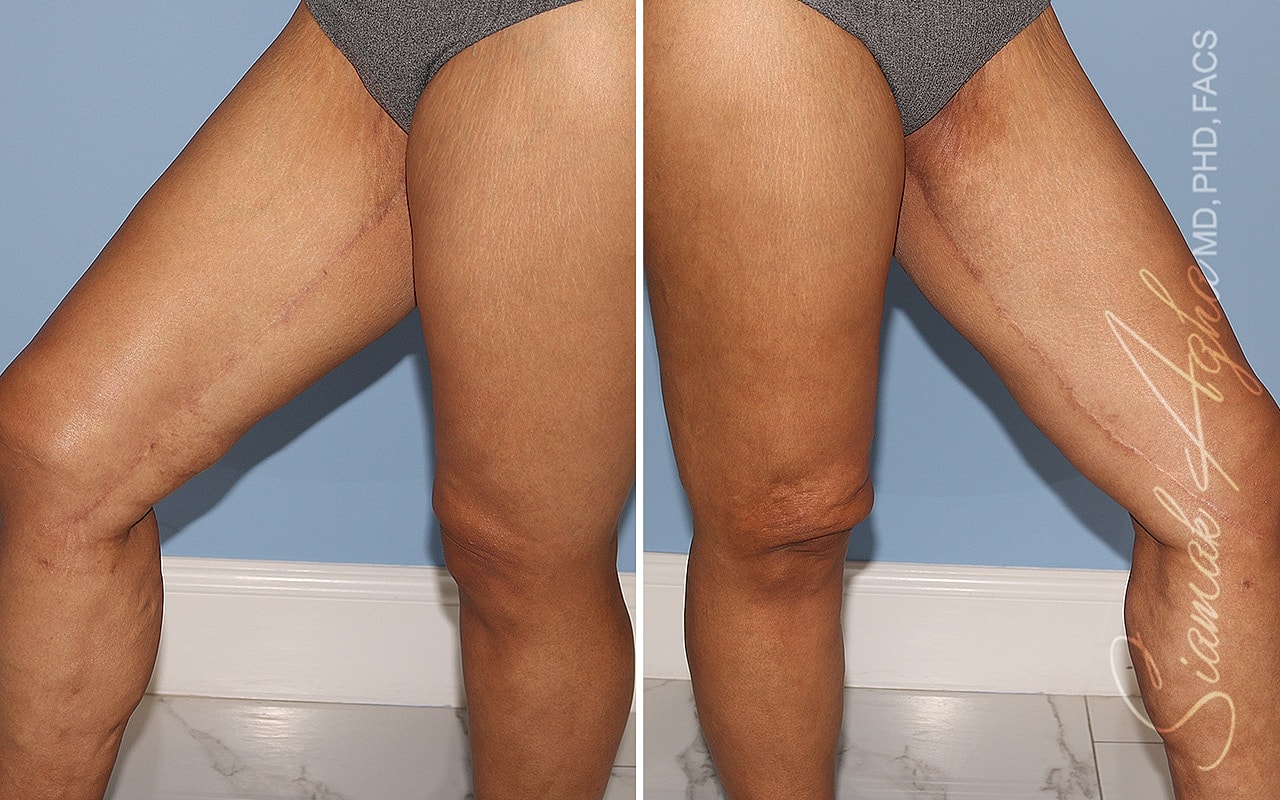 Healed Vertical Thighplasty scars extending down the inner thighs toward the knees