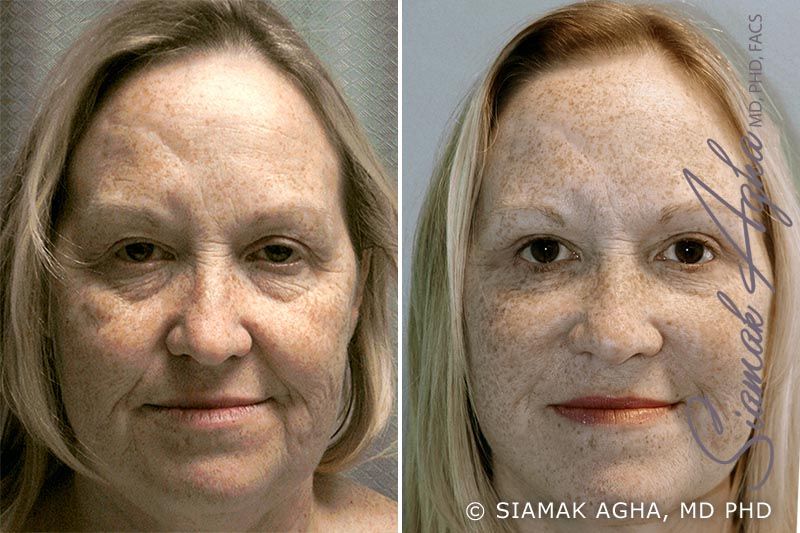 Facelift Before & After