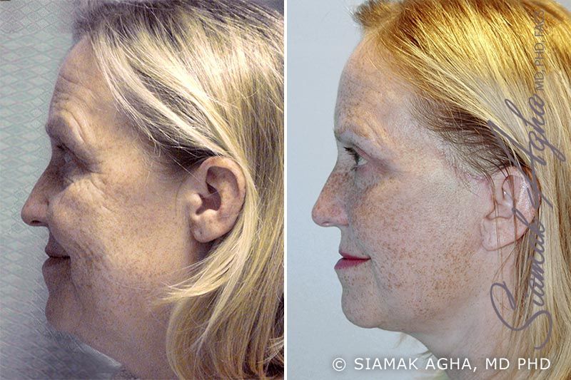 Facelift Before & After