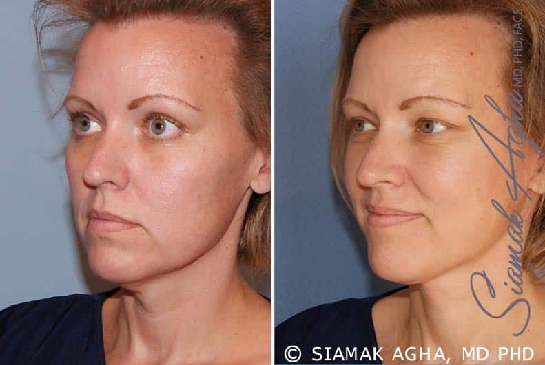 Facelift Before & After