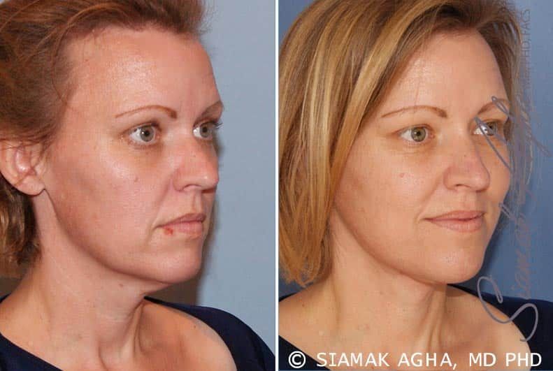 Facelift Before & After