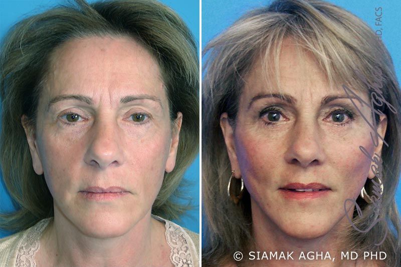 Facelift Before & After