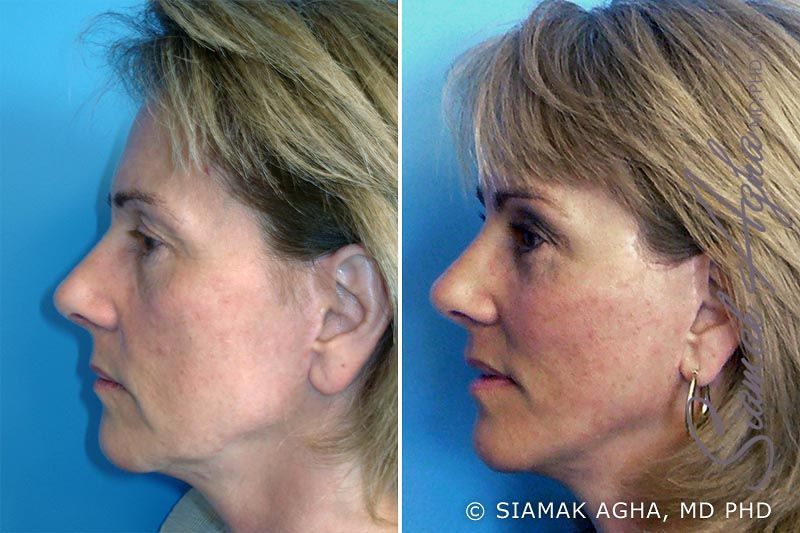 Facelift Before & After