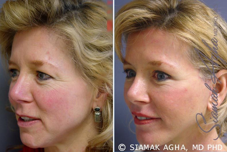 Facelift Before & After