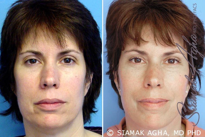 Facelift Before & After