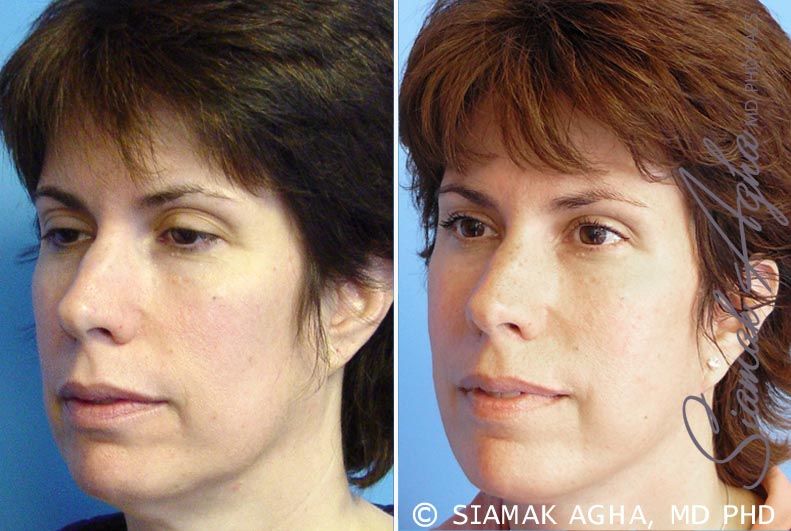 Facelift Before & After