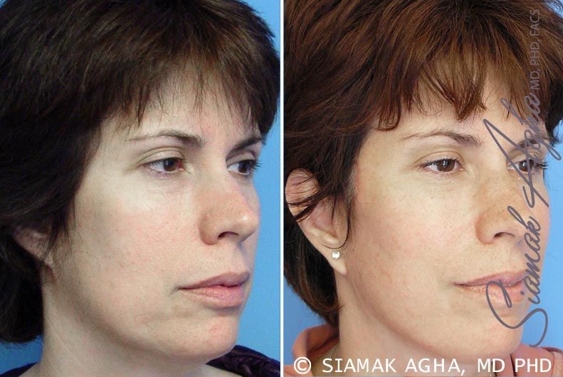 Facelift Before & After