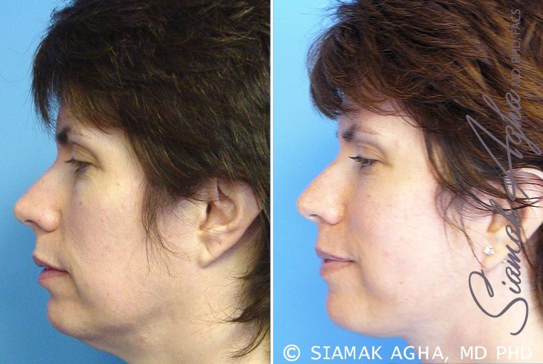 Facelift Before & After