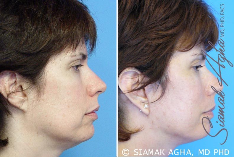 Facelift Before & After