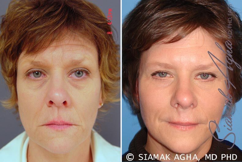 Facelift Before & After