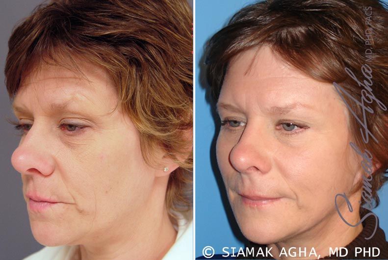Facelift Before & After