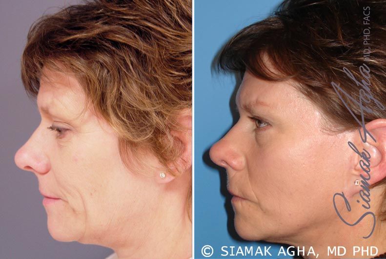 Facelift Before & After