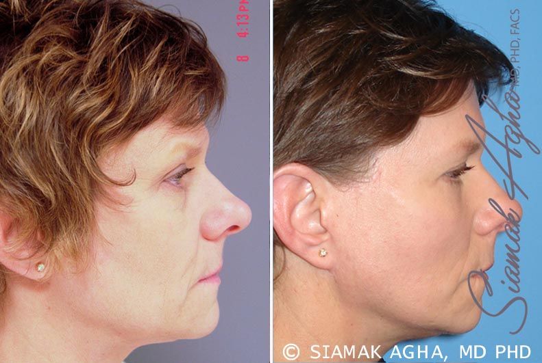 Facelift Before & After