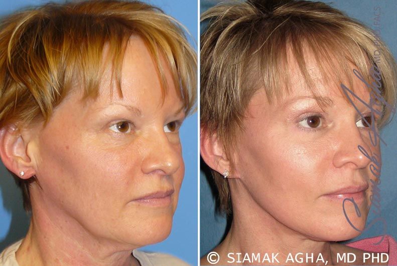 Facelift Before & After