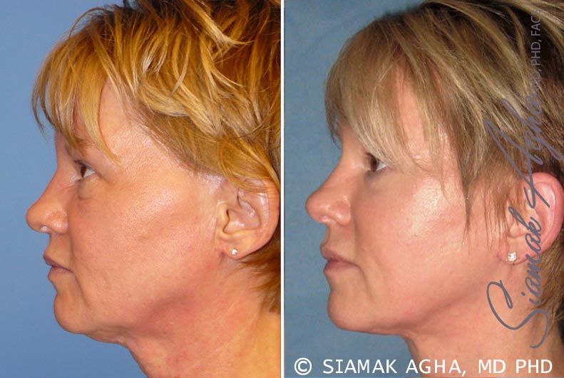 Facelift Before & After