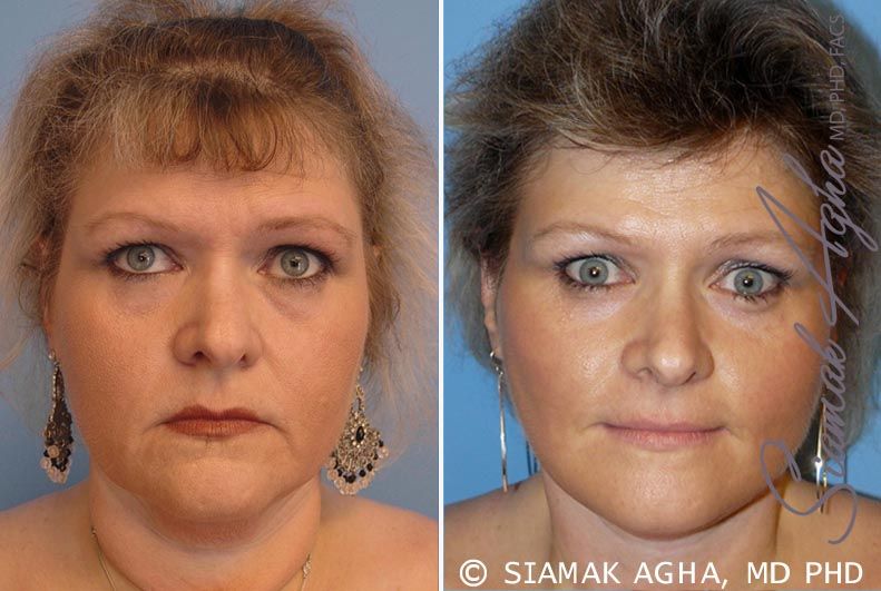 Facelift Before & After
