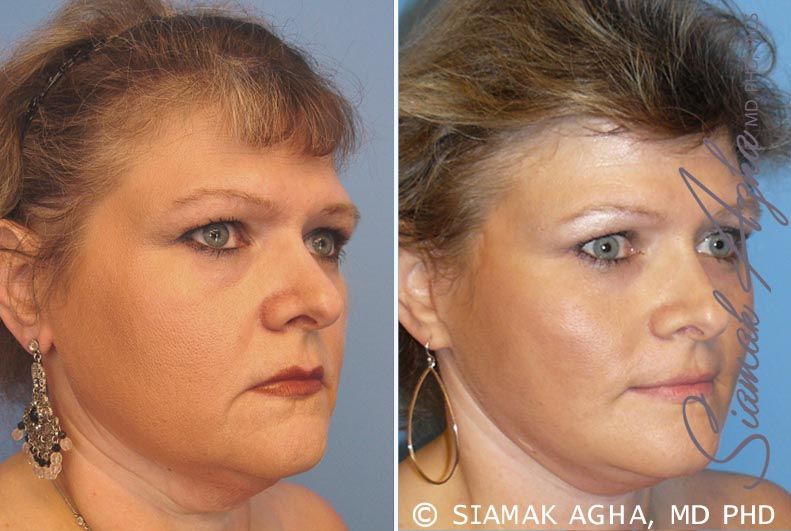 Facelift Before & After