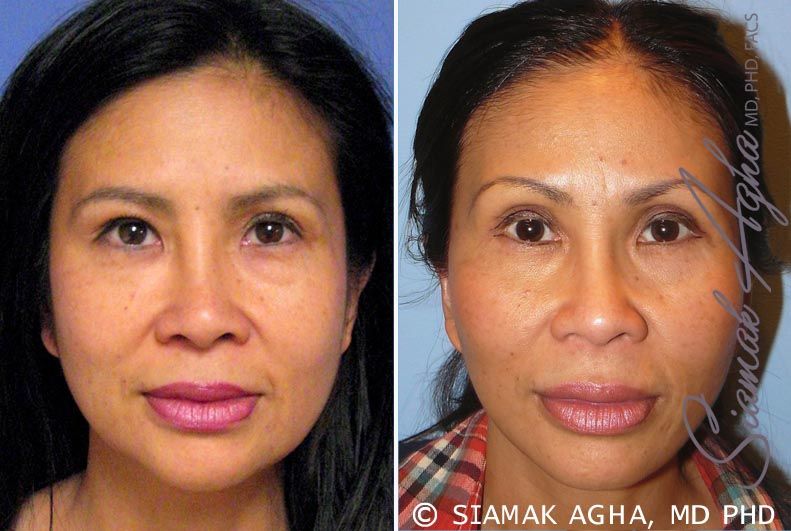 Facelift Before & After