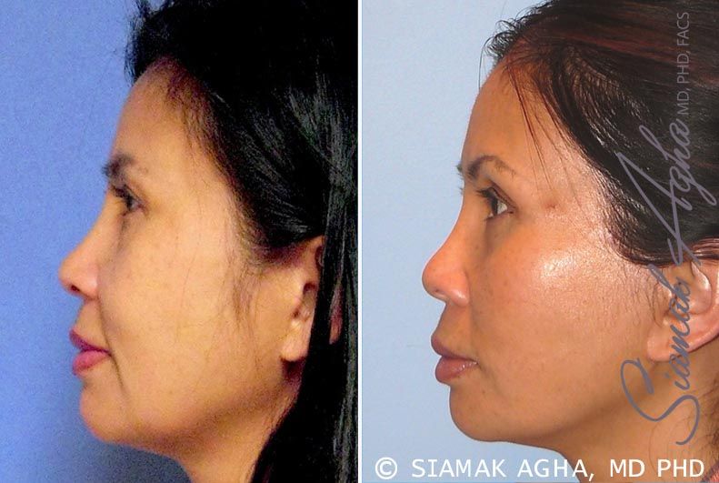 Facelift Before & After