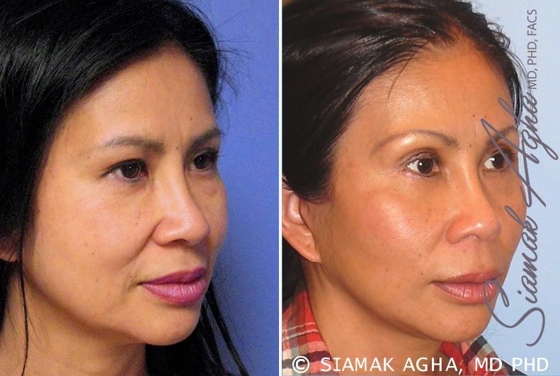 Facelift Before & After