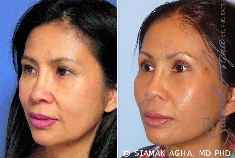 Facelift Before & After