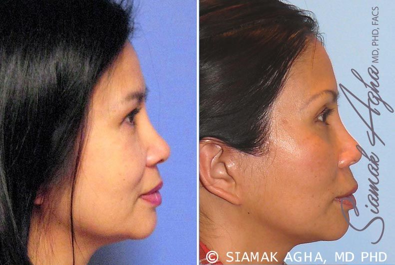 Facelift Before & After