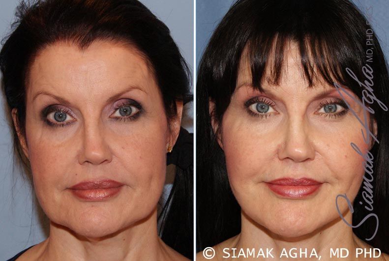 Facelift Before & After