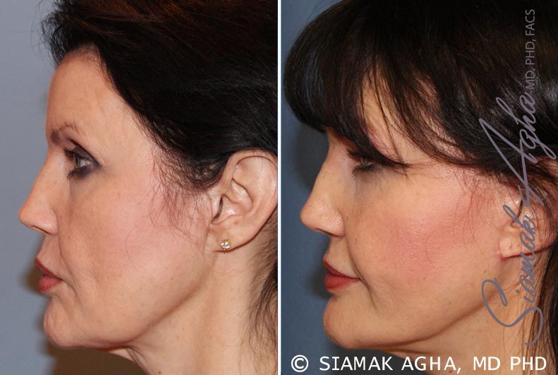 Facelift Before & After