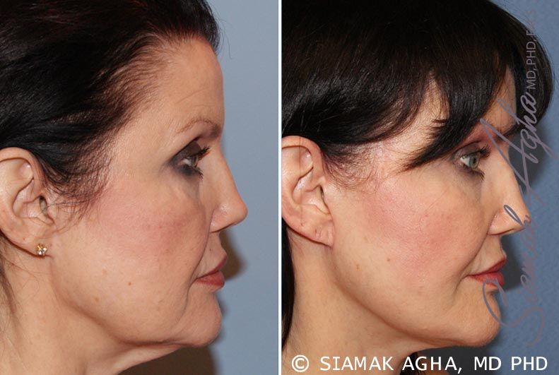 Facelift Before & After