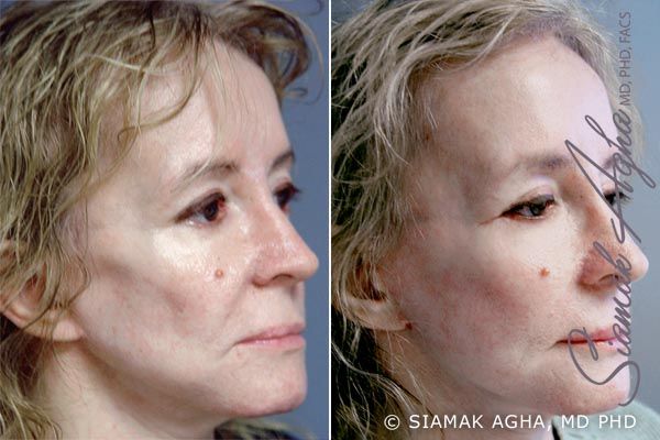 Facelift Before & After