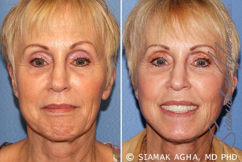 Facelift Before & After