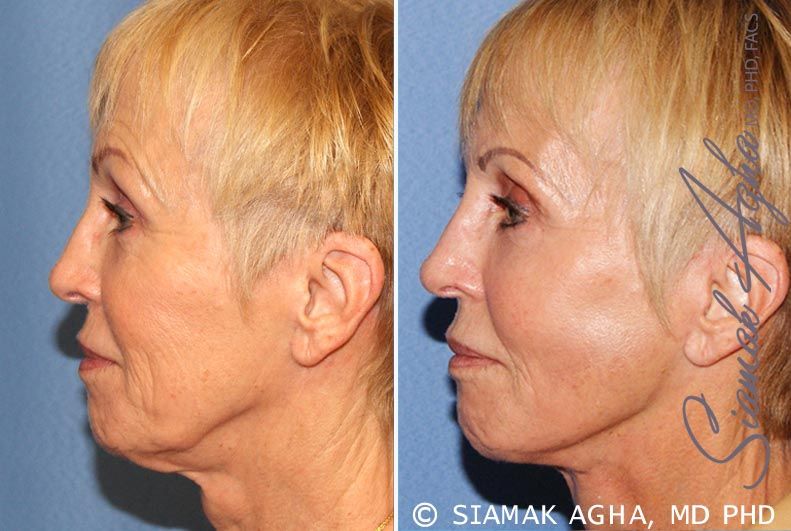 Facelift Before & After