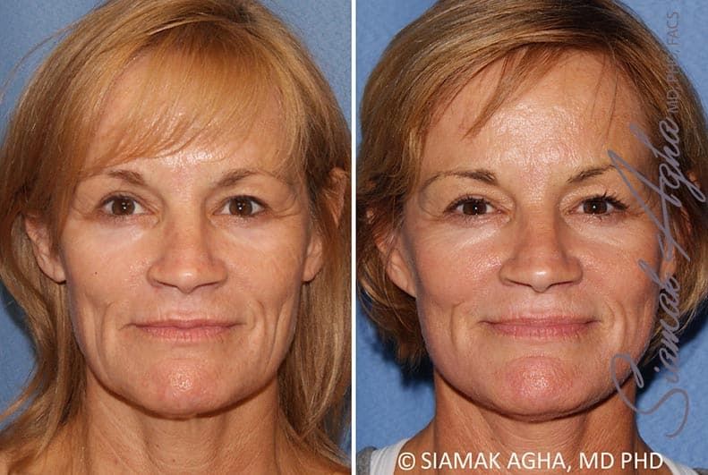 Facelift Before & After